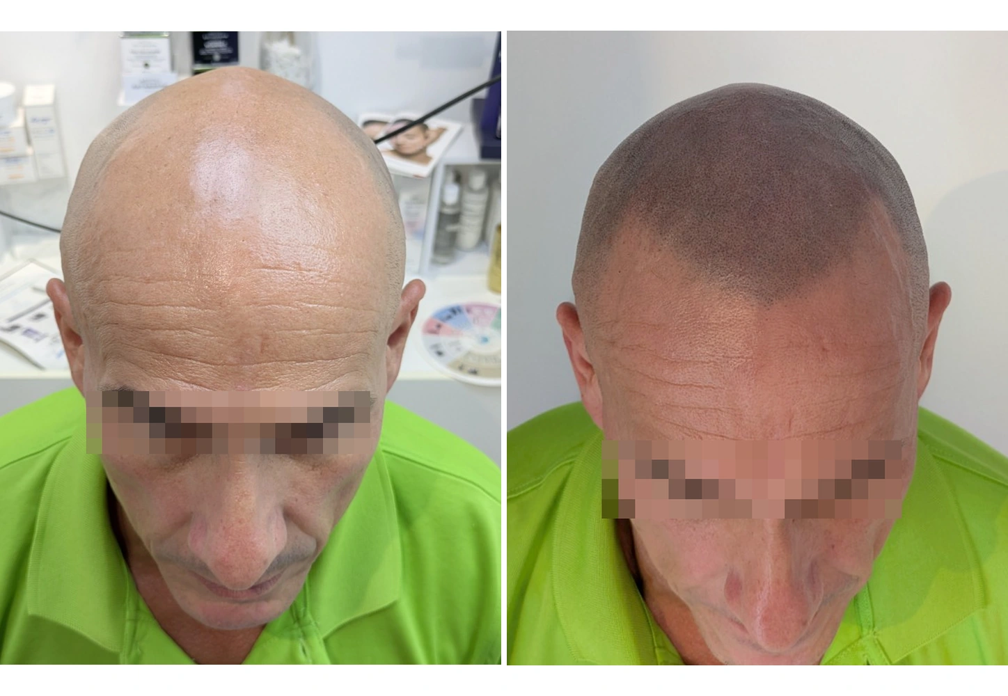 Antes y después de micropigmentación capilar con efecto rapado realizada por Toni Hernández en Alicante